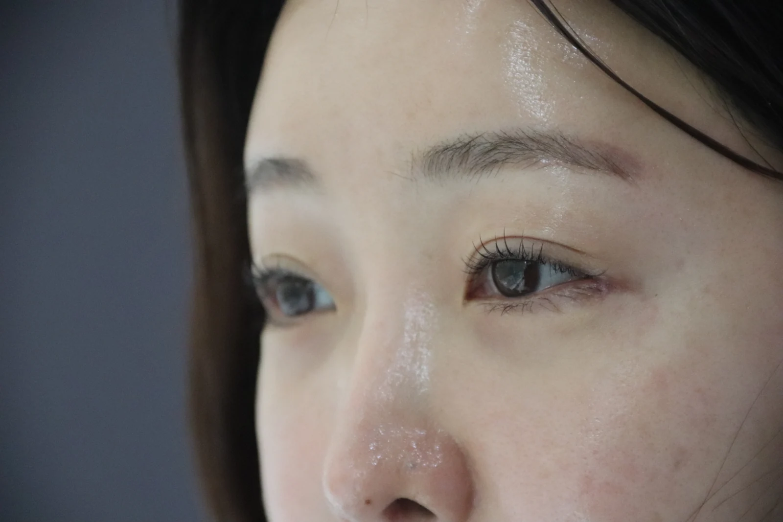 Lateral canthoplasty: recovery from surgery day to six months · Case 040 at Answer Plastic Surgery. One week, after suture removal: angled close-up of the eye area following the clinic’s case sequence for lateral canthoplasty, ANS-040.