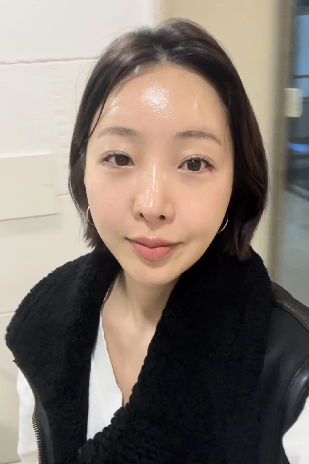 Lateral canthoplasty: recovery from surgery day to six months · Case 040 at Answer Plastic Surgery. One week, after suture removal: front view of the eye area following the clinic’s case sequence for lateral canthoplasty, ANS-040.
