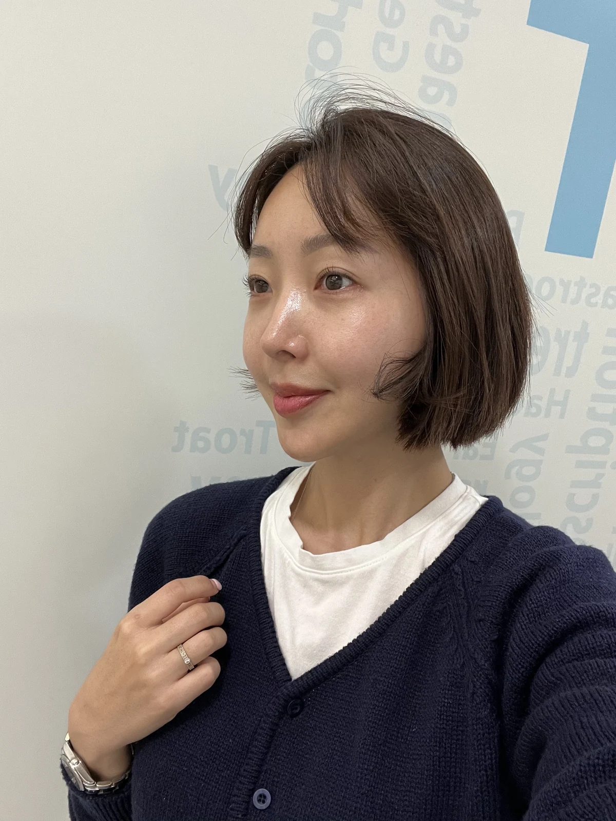 Lateral canthoplasty: recovery from surgery day to six months · Case 040 at Answer Plastic Surgery. Two months: angled view of the eye area following the clinic’s case sequence for lateral canthoplasty, ANS-040.
