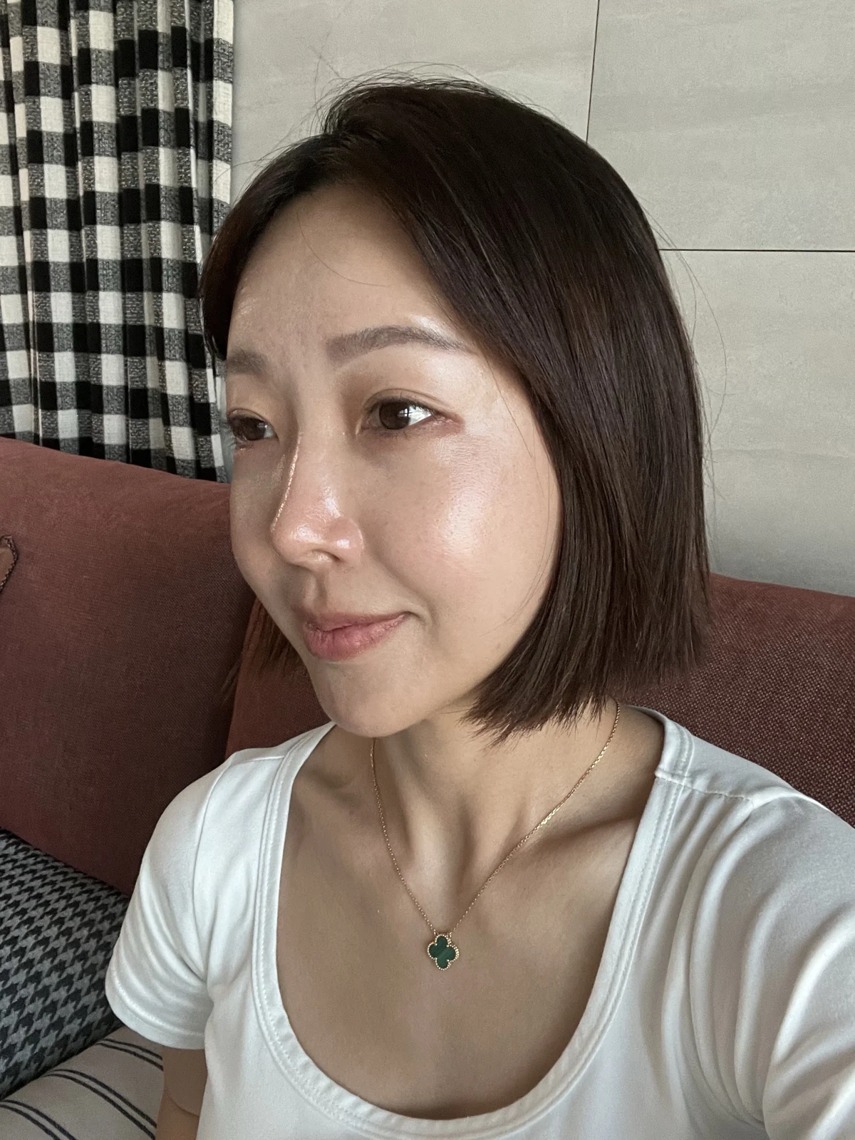 Lateral canthoplasty: recovery from surgery day to six months · Case 040 at Answer Plastic Surgery. Three months: angled view of the eye area following the clinic’s case sequence for lateral canthoplasty, ANS-040.
