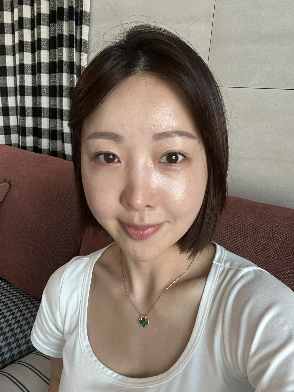 Lateral canthoplasty: recovery from surgery day to six months · Case 040 at Answer Plastic Surgery. Three months: front view of the eye area following the clinic’s case sequence for lateral canthoplasty, ANS-040.