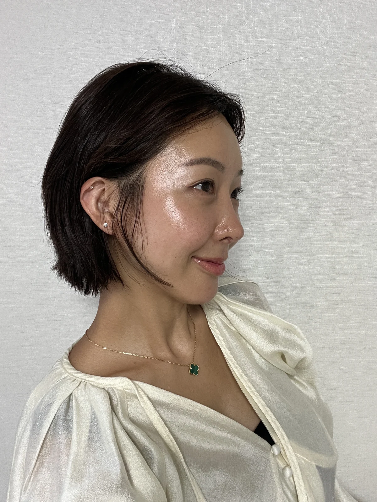 Lateral canthoplasty: recovery from surgery day to six months · Case 040 at Answer Plastic Surgery. Six months: angled view of the eye area following the clinic’s case sequence for lateral canthoplasty, ANS-040.