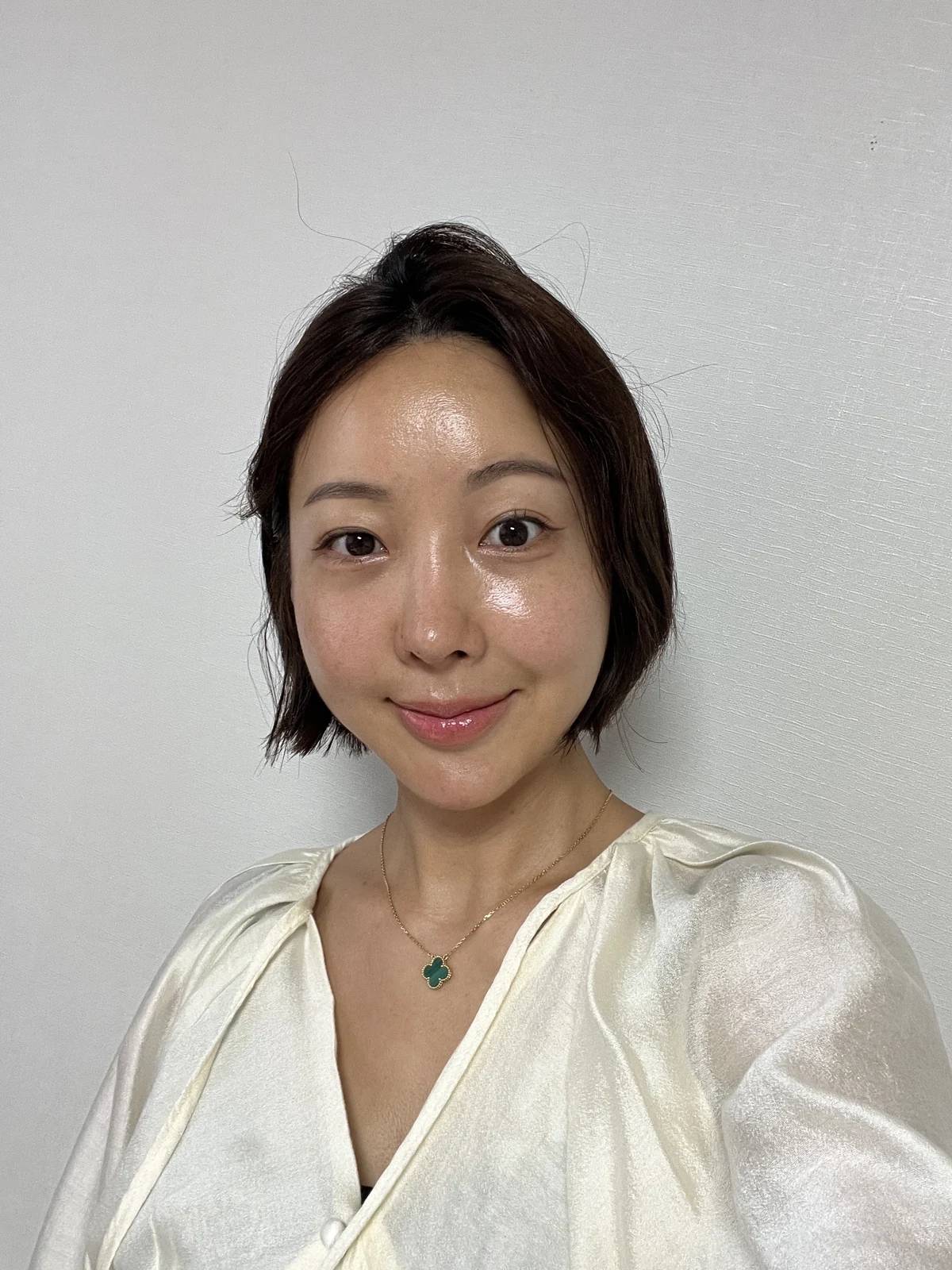 Lateral canthoplasty: recovery from surgery day to six months · Case 040 at Answer Plastic Surgery. Six months: front view of the eye area following the clinic’s case sequence for lateral canthoplasty, ANS-040.