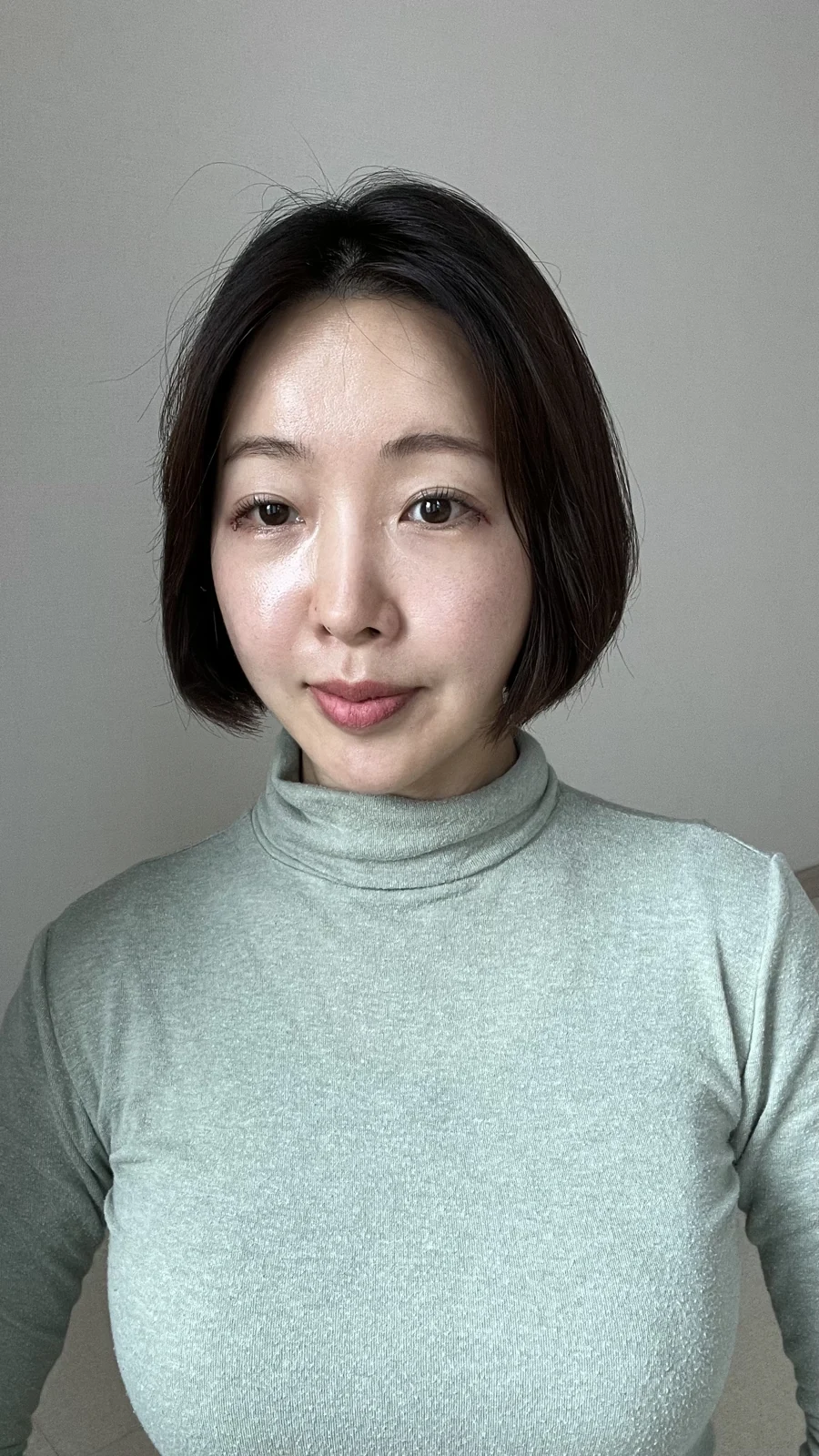 Lateral canthoplasty: recovery from surgery day to six months · Case 040 at Answer Plastic Surgery. Surgery day: front view of the eye area following the clinic’s case sequence for lateral canthoplasty, ANS-040.