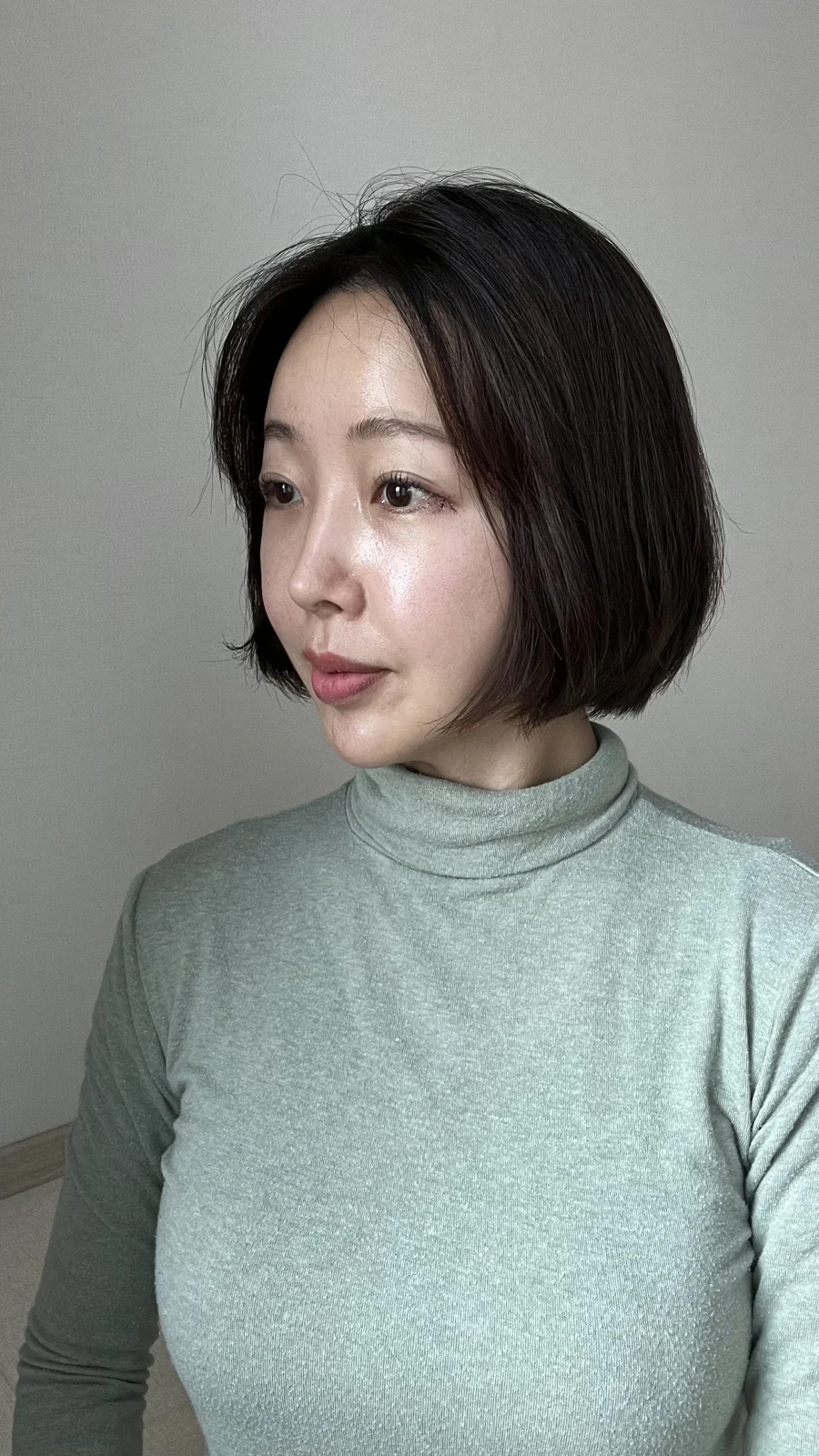 Lateral canthoplasty: recovery from surgery day to six months · Case 040 at Answer Plastic Surgery. Surgery day: angled view of the eye area following the clinic’s case sequence for lateral canthoplasty, ANS-040.