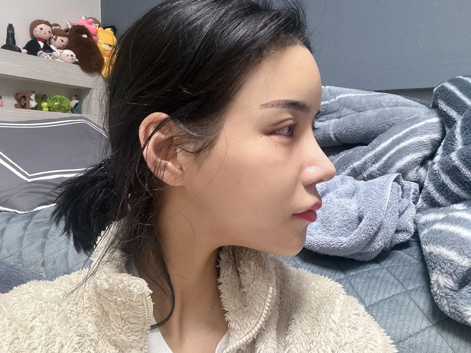 Rhinoplasty and eye surgery: a two-month photo diary · Case 024 at Answer Plastic Surgery. Profile view of the nose — 2 weeks at Answer Plastic Surgery.