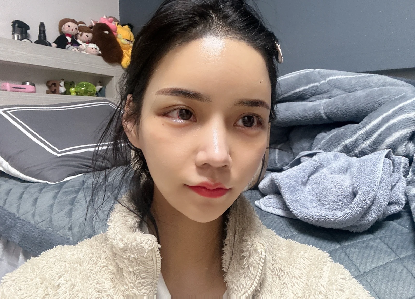 Rhinoplasty and eye surgery: a two-month photo diary · Case 024 at Answer Plastic Surgery. Front-facing view of the eyes and nose — 2 weeks at Answer Plastic Surgery.