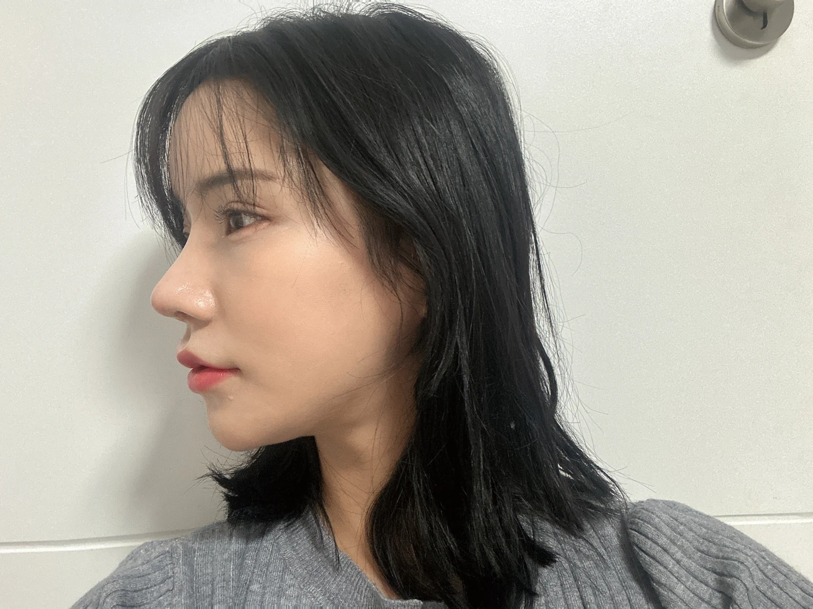 Rhinoplasty and eye surgery: a two-month photo diary · Case 024 at Answer Plastic Surgery. Profile view during recovery — 3 weeks at Answer Plastic Surgery.