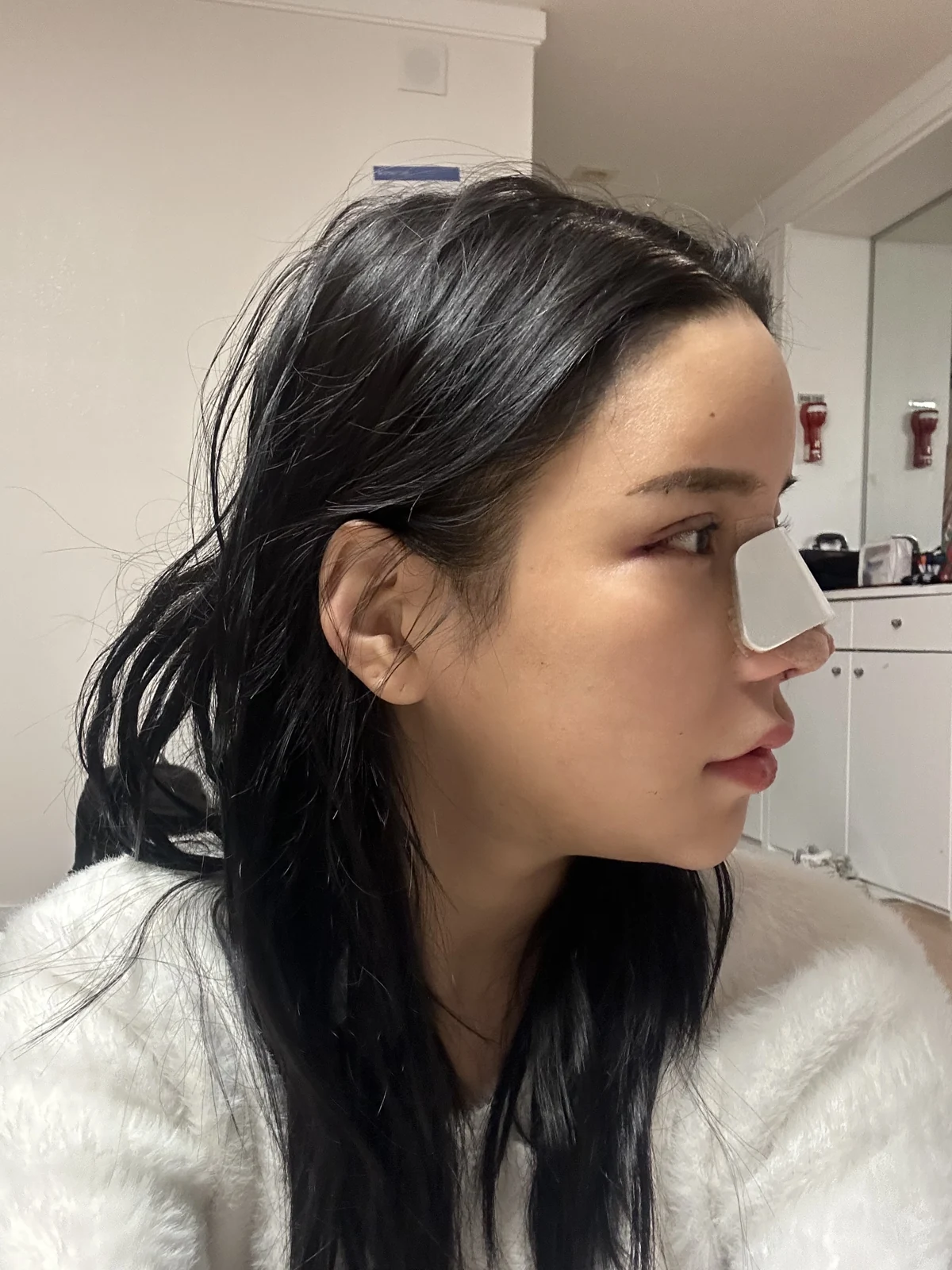 Rhinoplasty and eye surgery: a two-month photo diary · Case 024 at Answer Plastic Surgery. Profile view with a nasal splint — day of surgery at Answer Plastic Surgery.