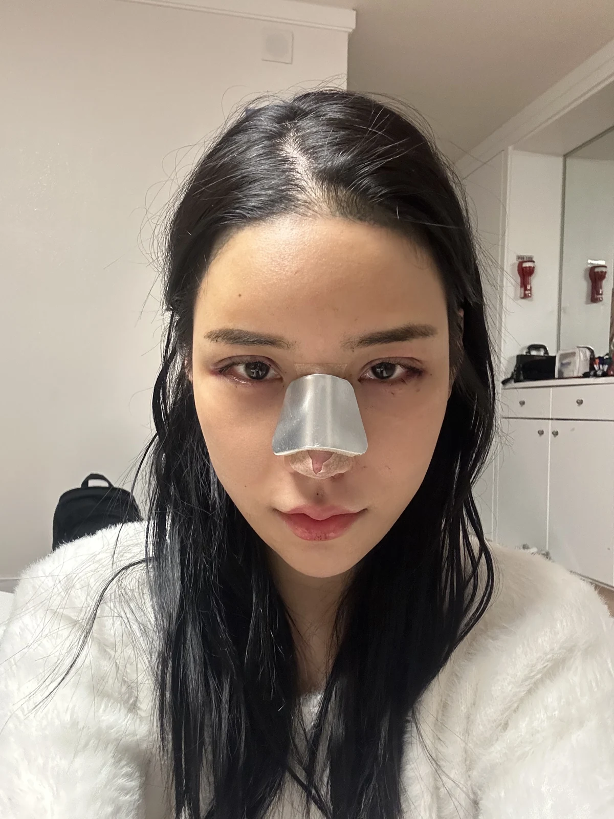 Rhinoplasty and eye surgery: a two-month photo diary · Case 024 at Answer Plastic Surgery. Front view with a nasal splint — day of surgery at Answer Plastic Surgery.