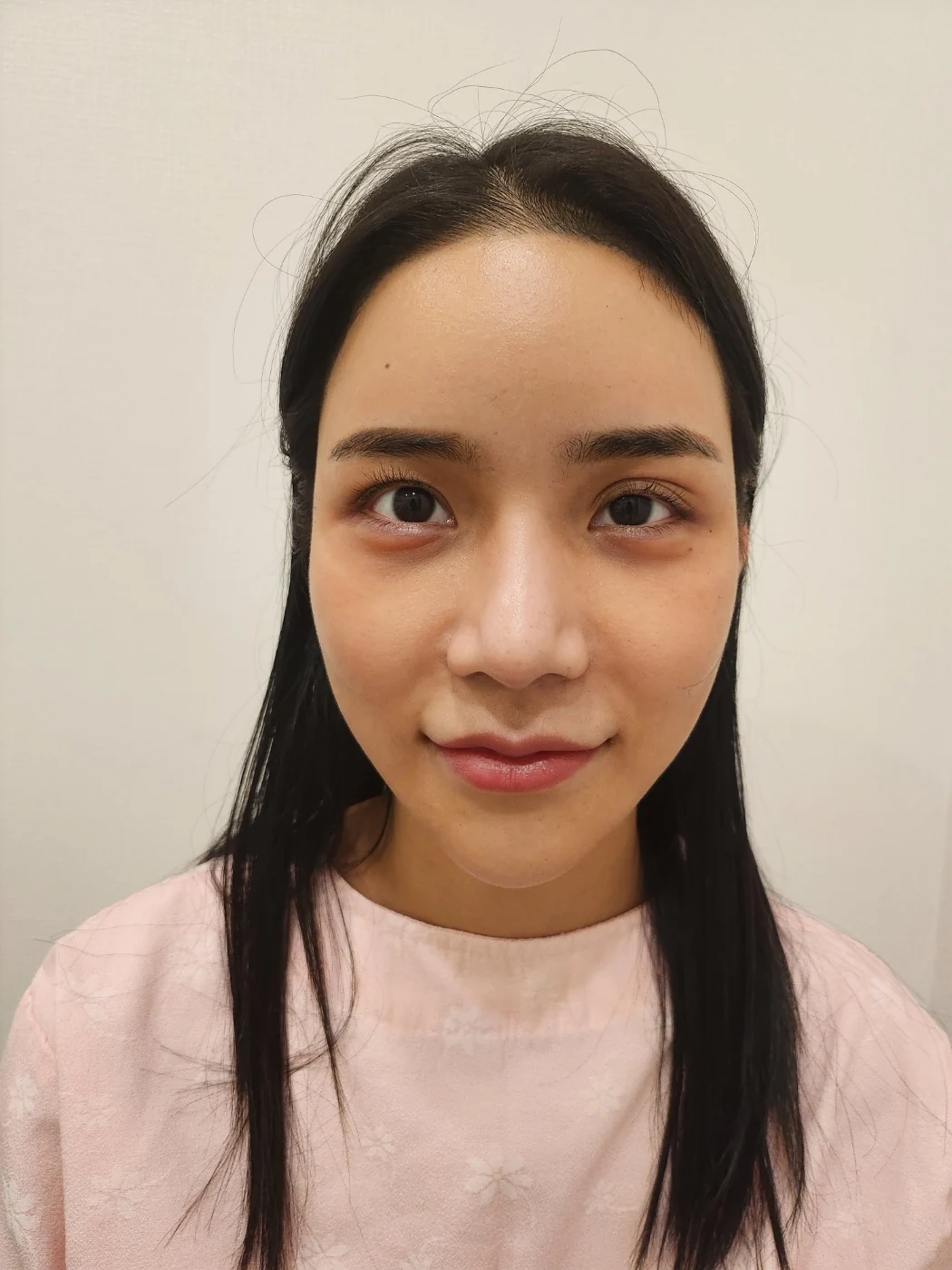 Rhinoplasty and eye surgery: a two-month photo diary · Case 024 at Answer Plastic Surgery. Front view before combined nose and eye surgery — before at Answer Plastic Surgery.