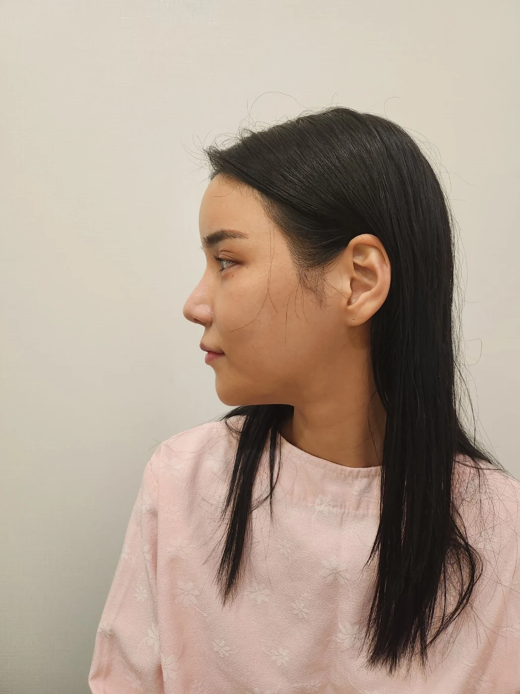 Rhinoplasty and eye surgery: a two-month photo diary · Case 024 at Answer Plastic Surgery. Profile view before combined surgery — before at Answer Plastic Surgery.