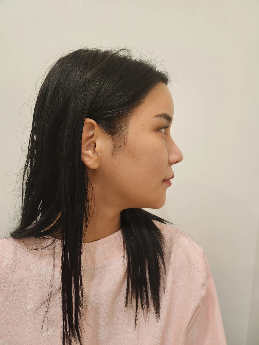 Rhinoplasty and eye surgery: a two-month photo diary · Case 024 at Answer Plastic Surgery. Opposite profile view before combined surgery — before at Answer Plastic Surgery.