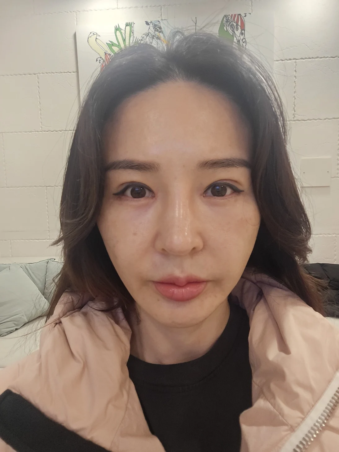 Facial before-and-after photographs through three months · Case 025 at Answer Plastic Surgery. Front follow-up photograph — 1 month at Answer Plastic Surgery.