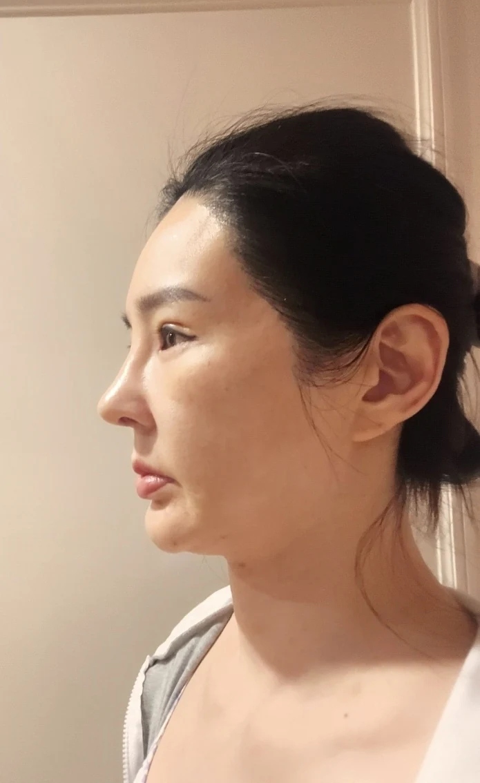 Facial before-and-after photographs through three months · Case 025 at Answer Plastic Surgery. Profile view in the follow-up sequence — 1 week at Answer Plastic Surgery.