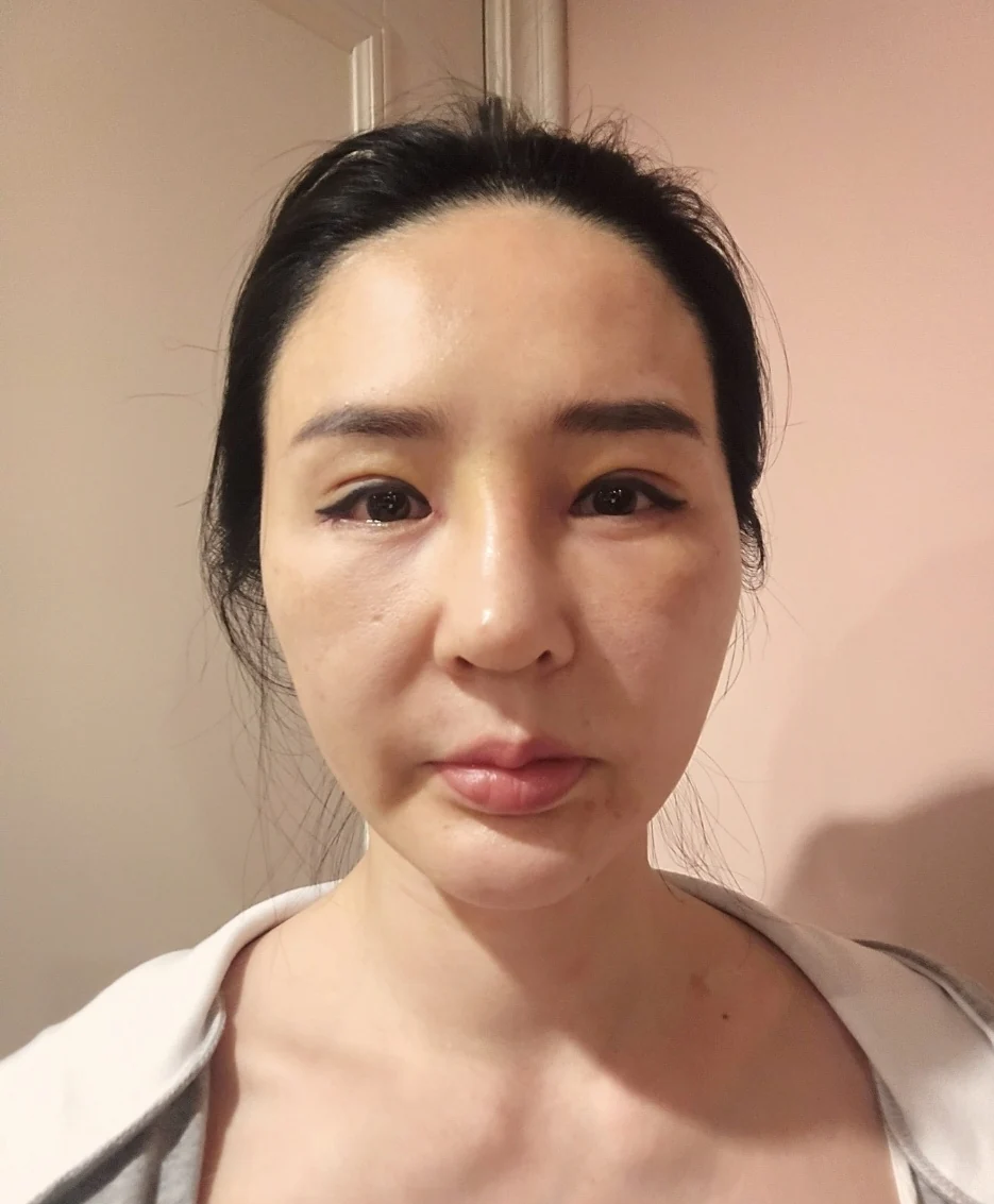 Facial before-and-after photographs through three months · Case 025 at Answer Plastic Surgery. Front view in the follow-up sequence — 1 week at Answer Plastic Surgery.
