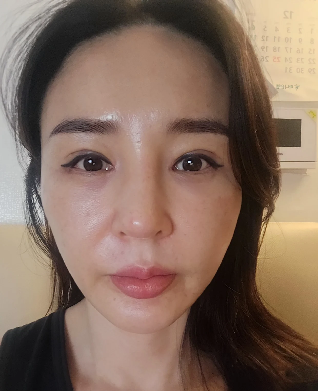 Facial before-and-after photographs through three months · Case 025 at Answer Plastic Surgery. Front follow-up photograph — 2 weeks at Answer Plastic Surgery.