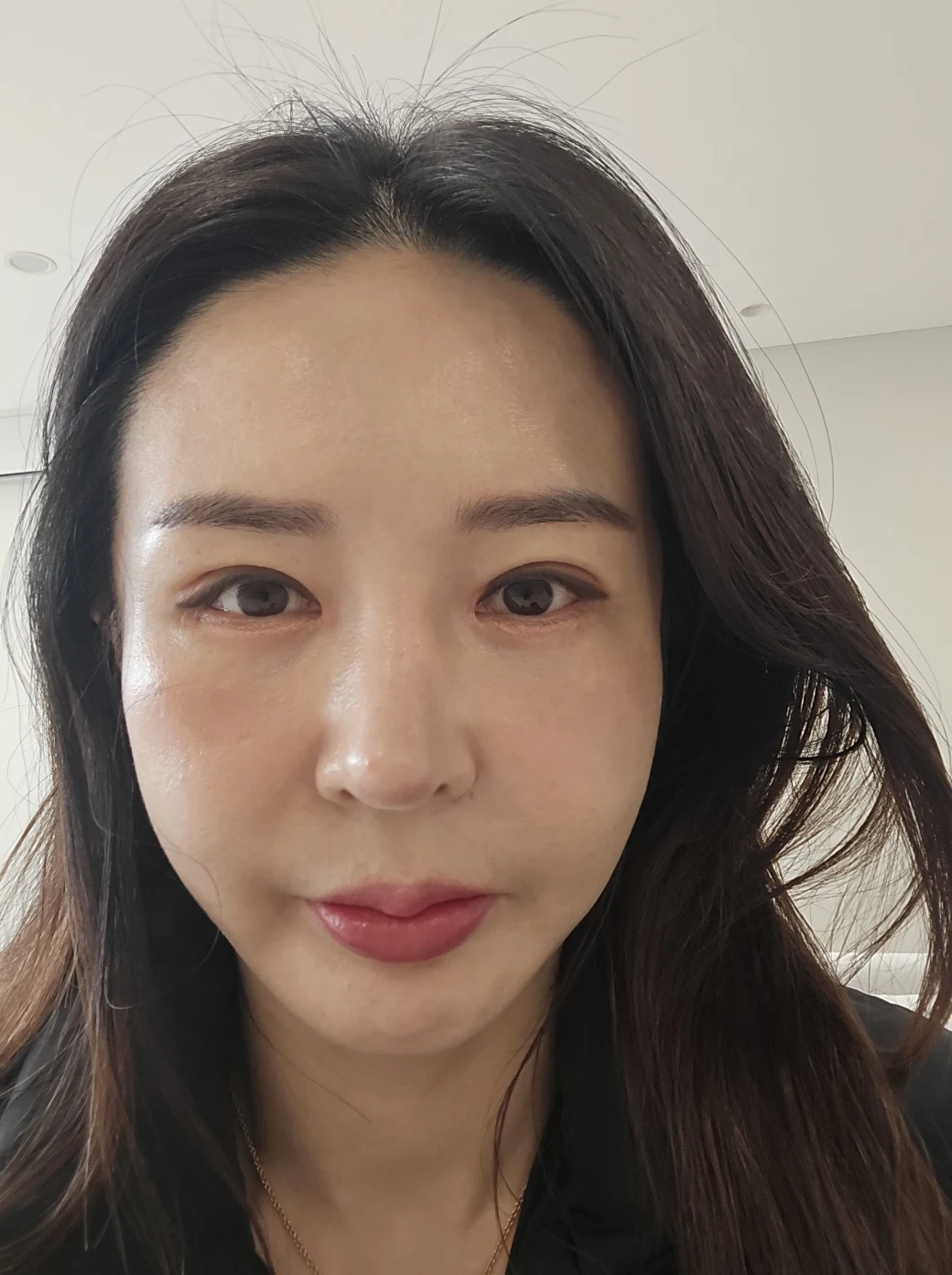 Facial before-and-after photographs through three months · Case 025 at Answer Plastic Surgery. Front follow-up photograph — 3 months at Answer Plastic Surgery.