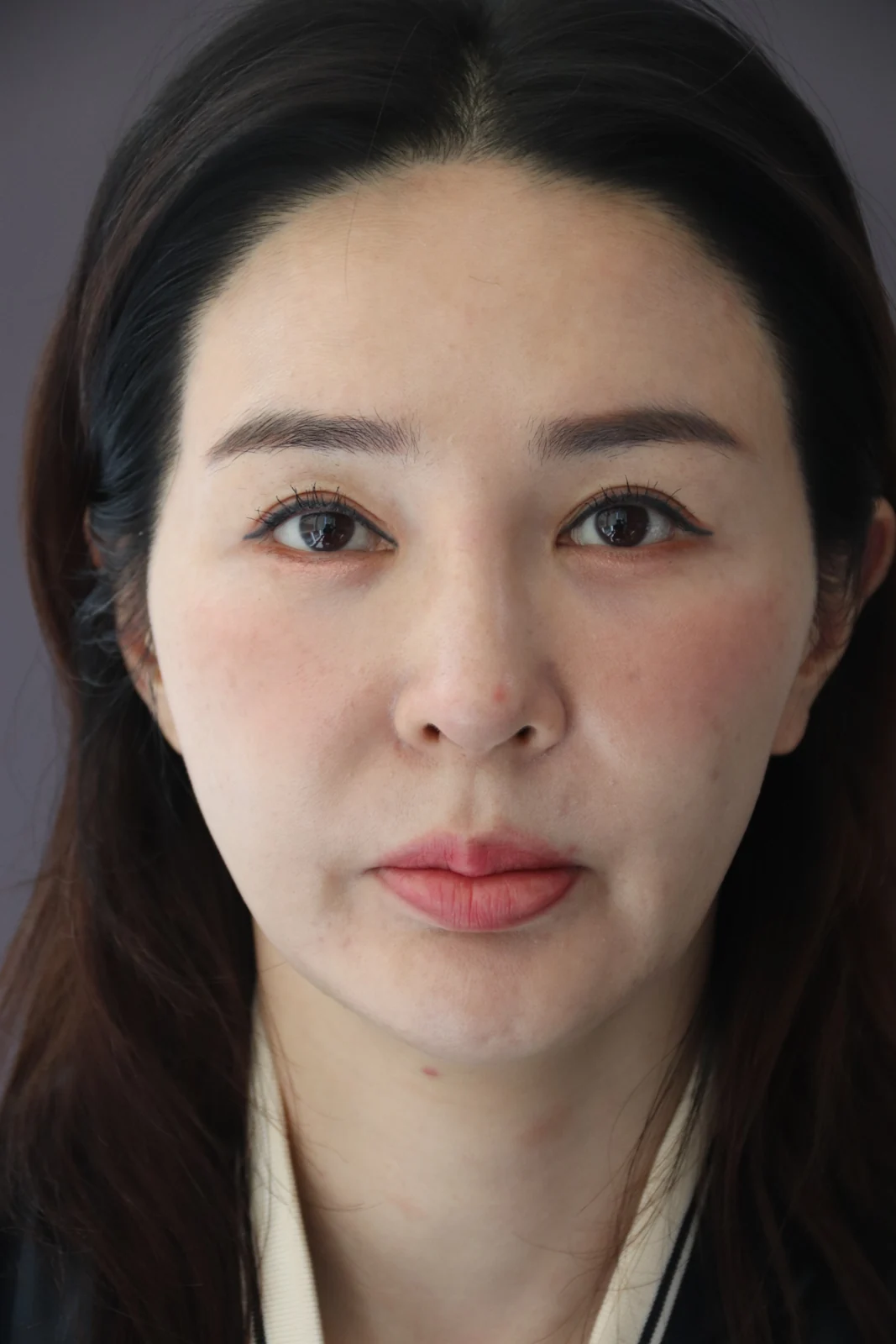 Facial before-and-after photographs through three months · Case 025 at Answer Plastic Surgery. Front view of the face — before at Answer Plastic Surgery.