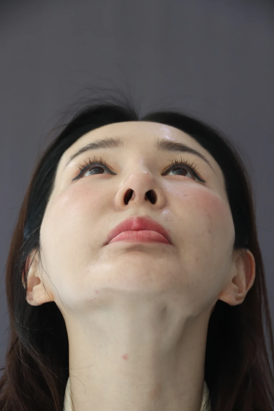Facial before-and-after photographs through three months · Case 025 at Answer Plastic Surgery. Upward view of the face and nasal base — before at Answer Plastic Surgery.