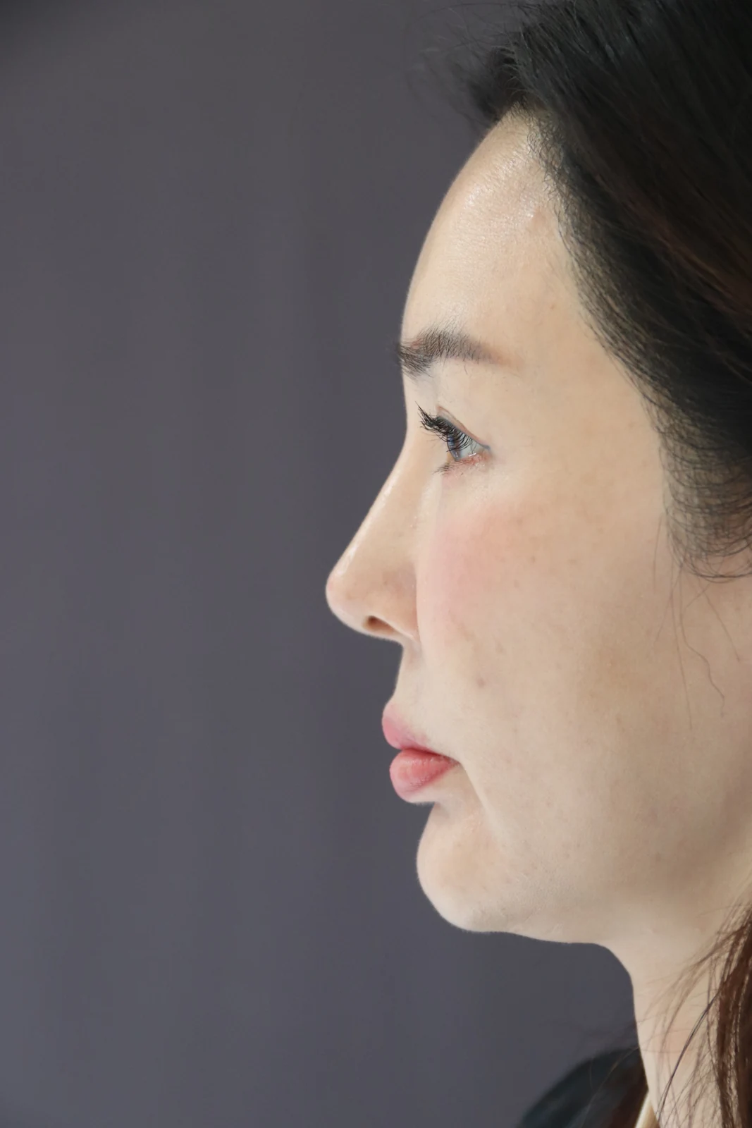 Facial before-and-after photographs through three months · Case 025 at Answer Plastic Surgery. Profile view of the face — before at Answer Plastic Surgery.