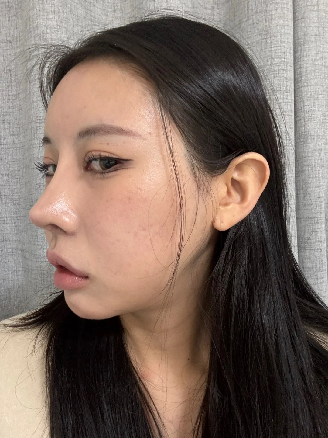 Lateral and lower canthoplasty: the first month · Case 026 at Answer Plastic Surgery. Oblique view after canthoplasty, with eye makeup — 1 month at Answer Plastic Surgery.