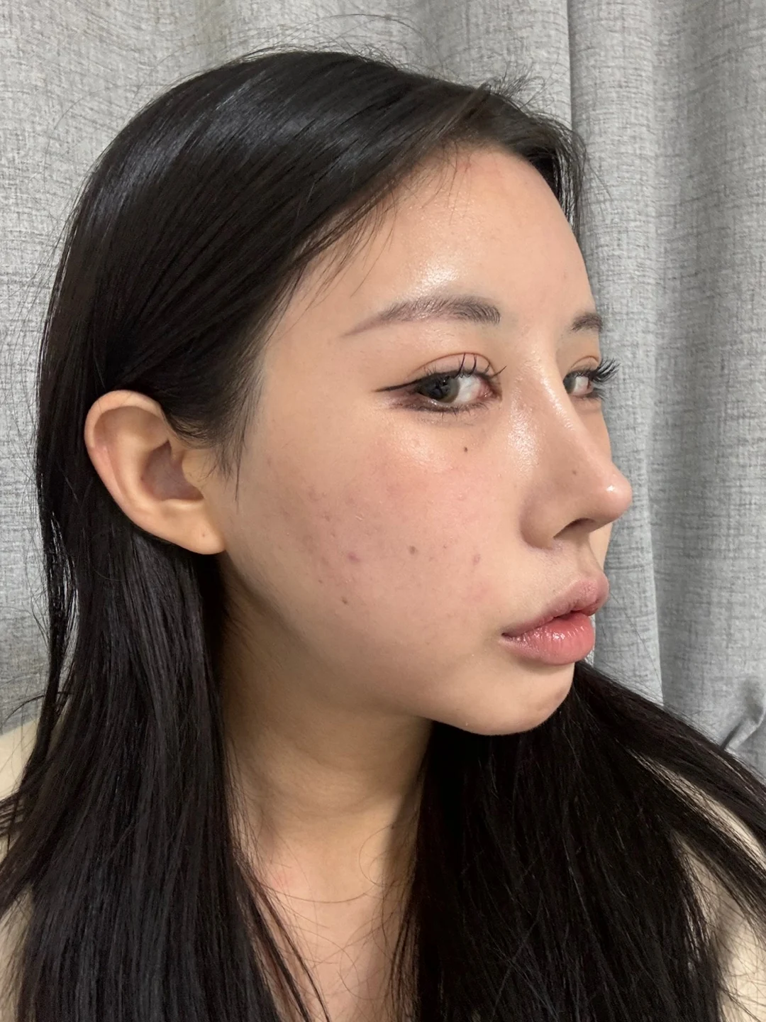 Lateral and lower canthoplasty: the first month · Case 026 at Answer Plastic Surgery. Opposite oblique view after canthoplasty, with eye makeup — 1 month at Answer Plastic Surgery.