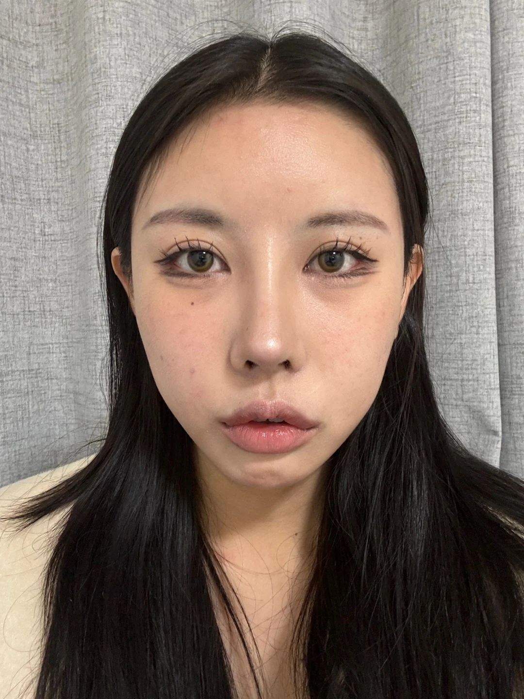 Lateral and lower canthoplasty: the first month · Case 026 at Answer Plastic Surgery. Front view after canthoplasty, with eye makeup — 1 month at Answer Plastic Surgery.