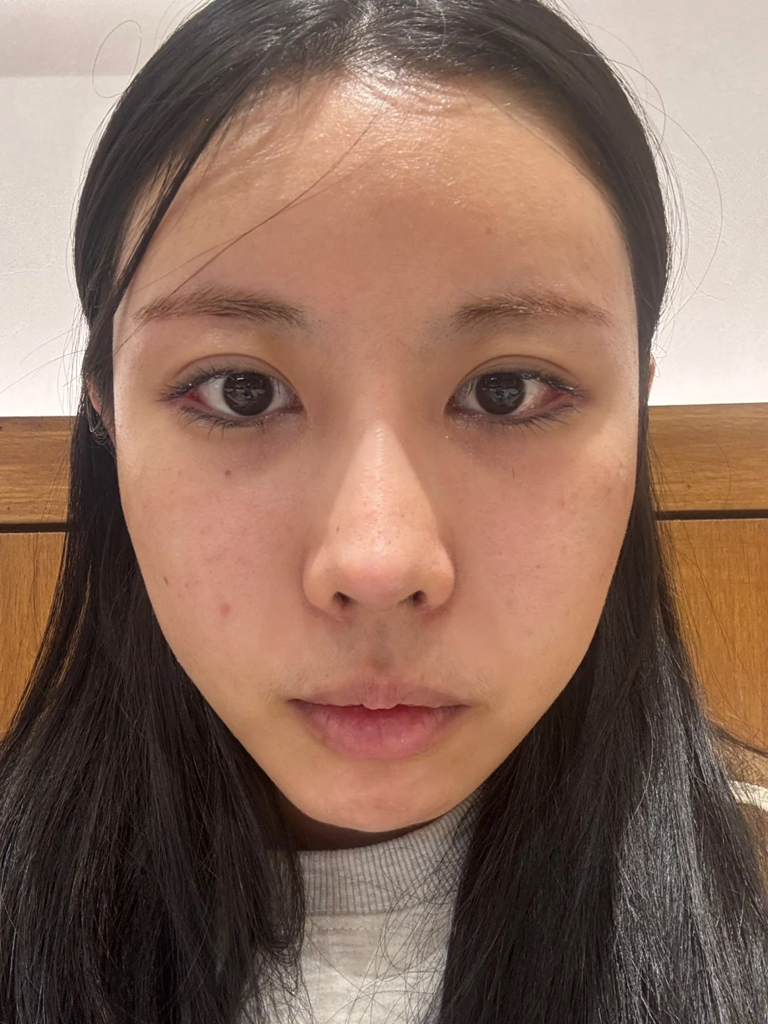 Lateral and lower canthoplasty: the first month · Case 026 at Answer Plastic Surgery. Front view during canthoplasty recovery — 1 week at Answer Plastic Surgery.