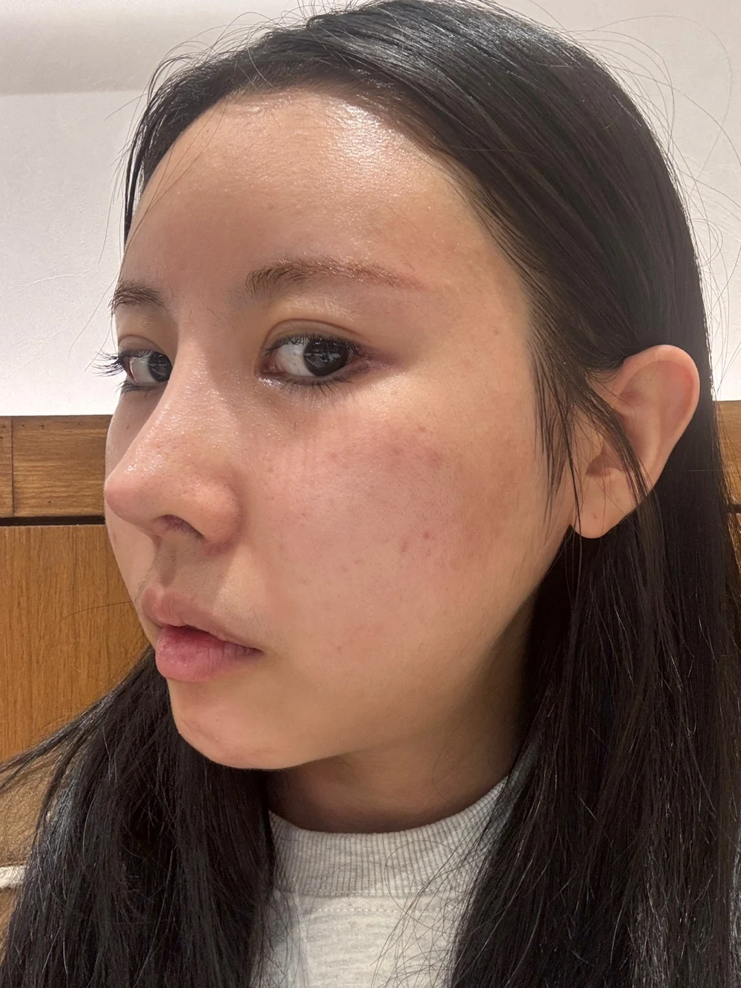 Lateral and lower canthoplasty: the first month · Case 026 at Answer Plastic Surgery. Oblique view during canthoplasty recovery — 1 week at Answer Plastic Surgery.