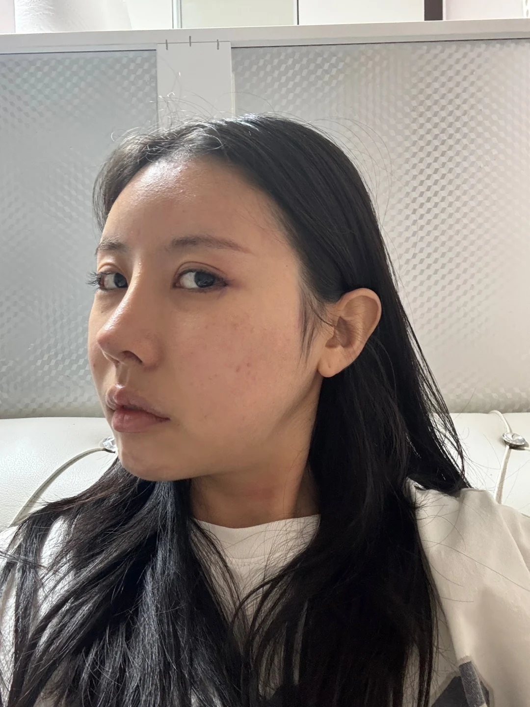 Lateral and lower canthoplasty: the first month · Case 026 at Answer Plastic Surgery. Oblique view after eye-corner surgery — day of surgery at Answer Plastic Surgery.
