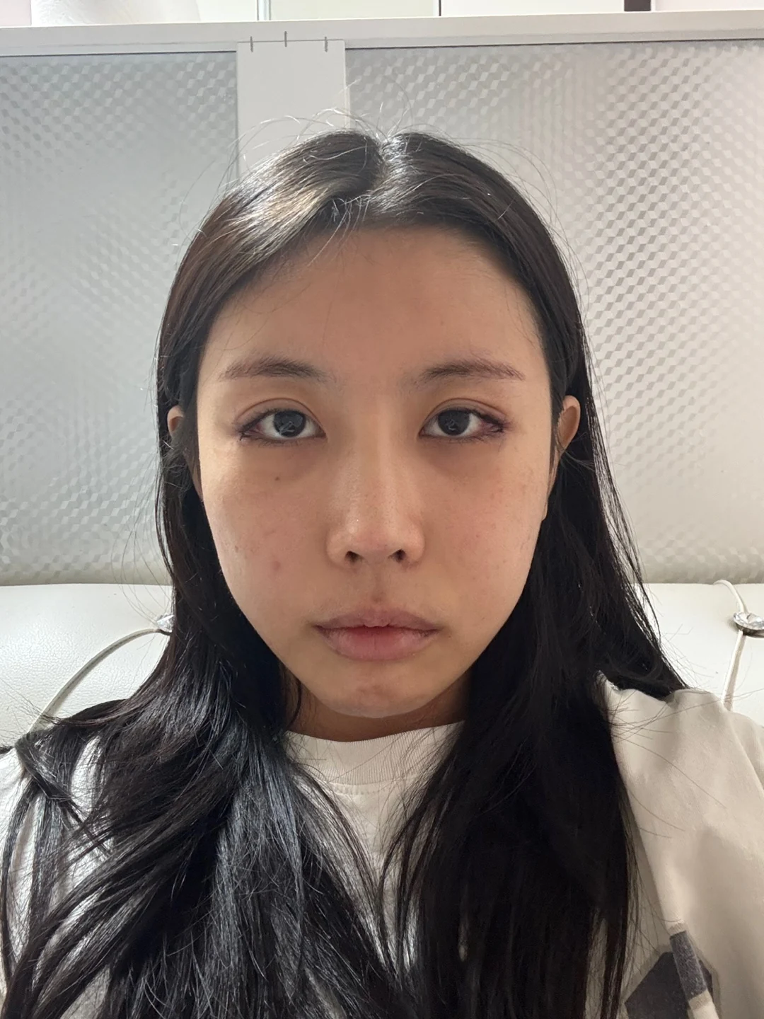 Lateral and lower canthoplasty: the first month · Case 026 at Answer Plastic Surgery. Front view after eye-corner surgery — day of surgery at Answer Plastic Surgery.