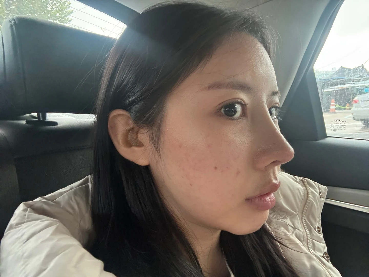 Lateral and lower canthoplasty: the first month · Case 026 at Answer Plastic Surgery. Oblique view of the outer eye corner — before at Answer Plastic Surgery.
