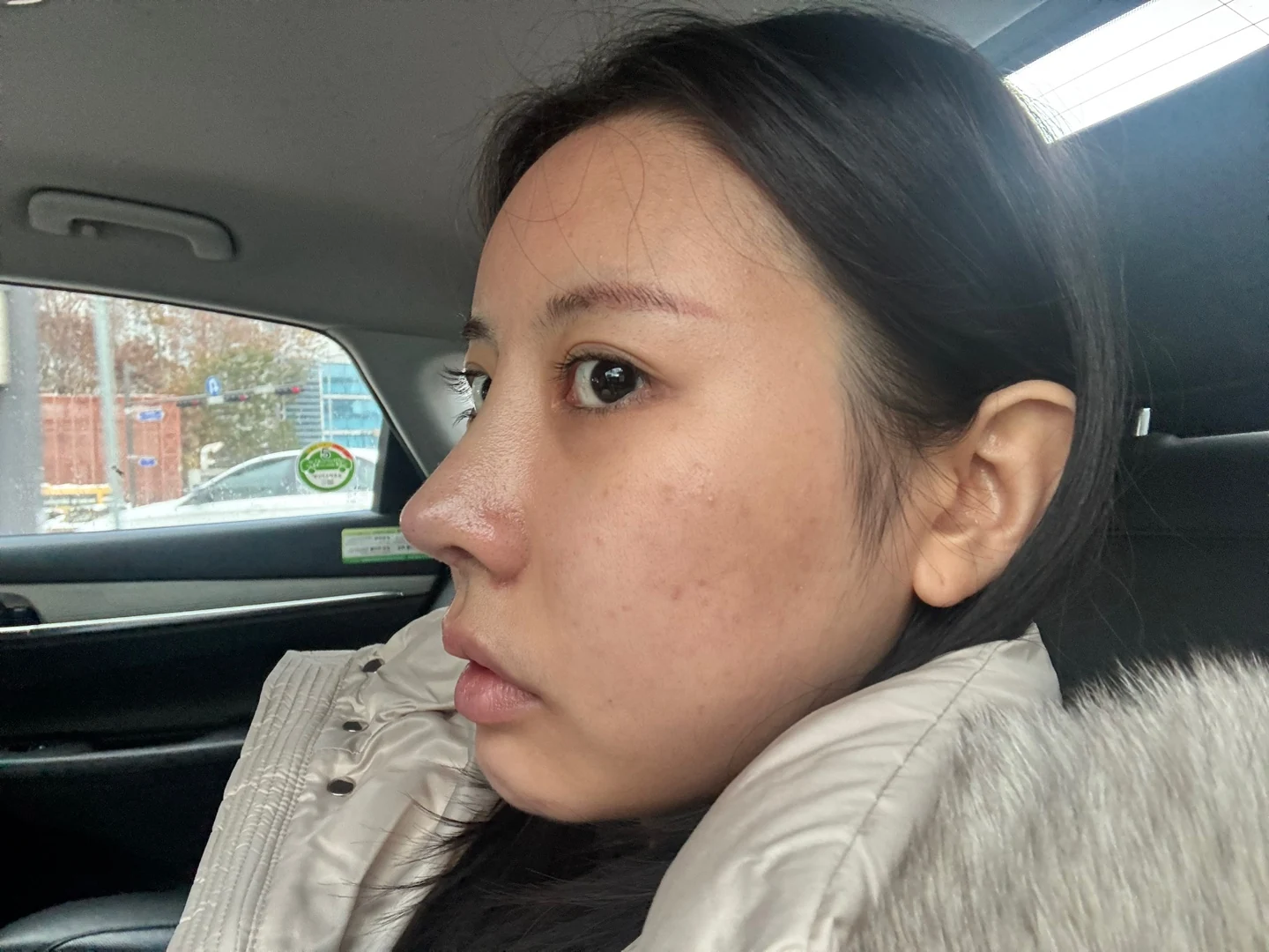 Lateral and lower canthoplasty: the first month · Case 026 at Answer Plastic Surgery. Opposite oblique view of the outer eye corner — before at Answer Plastic Surgery.