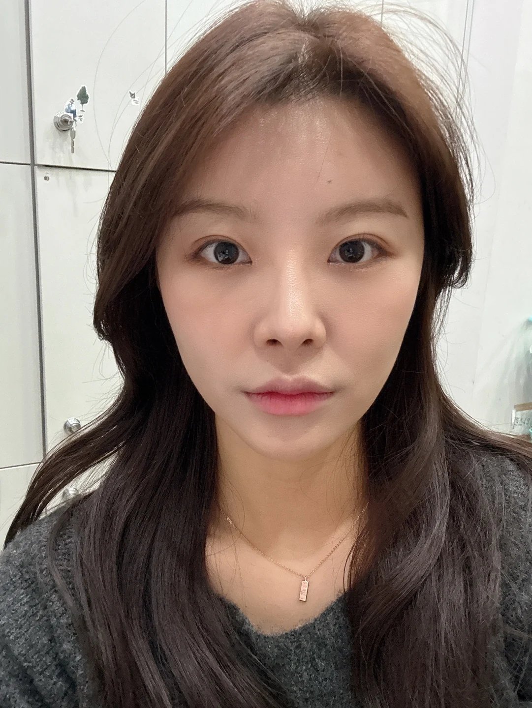 Eye surgery: the first month in photos · Case 027 at Answer Plastic Surgery. Front view — 1 month at Answer Plastic Surgery.