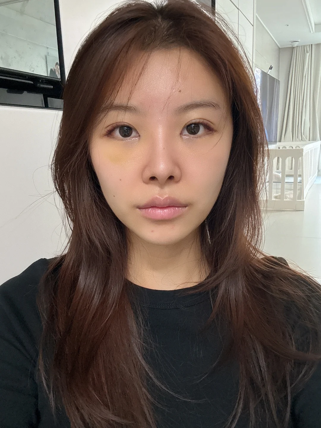 Eye surgery: the first month in photos · Case 027 at Answer Plastic Surgery. Front view — 1 week at Answer Plastic Surgery.