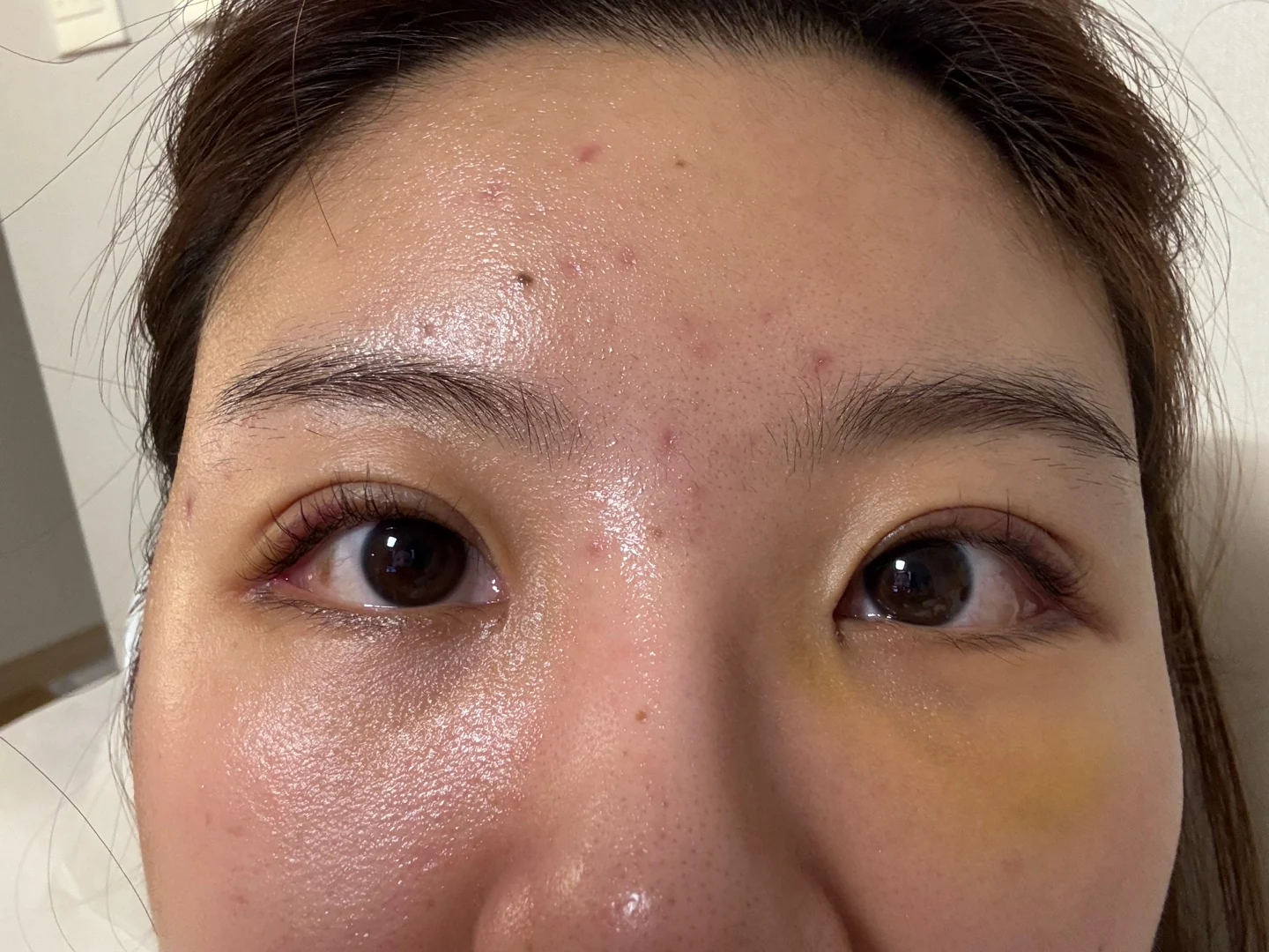 Eye surgery: the first month in photos · Case 027 at Answer Plastic Surgery. Eye-area close-up with visible bruising — 1 week at Answer Plastic Surgery.