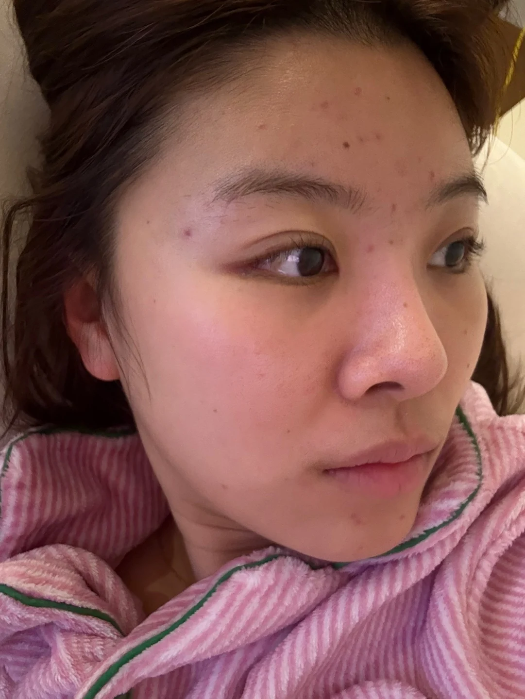 Eye surgery: the first month in photos · Case 027 at Answer Plastic Surgery. Oblique view — 3 weeks at Answer Plastic Surgery.