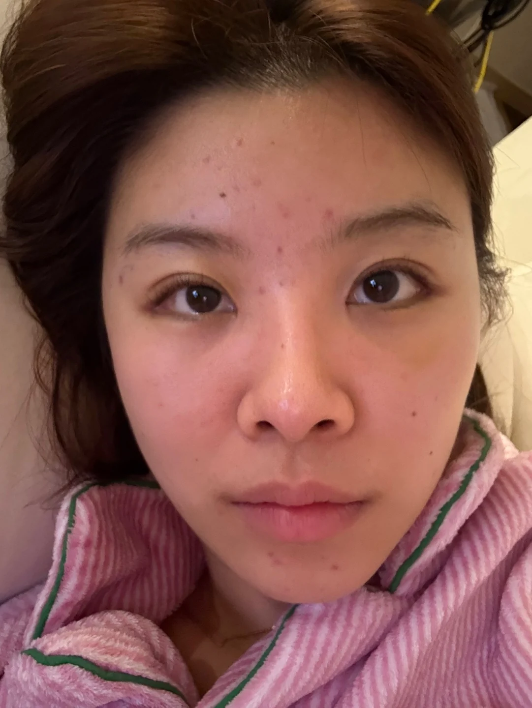 Eye surgery: the first month in photos · Case 027 at Answer Plastic Surgery. Front view — 3 weeks at Answer Plastic Surgery.