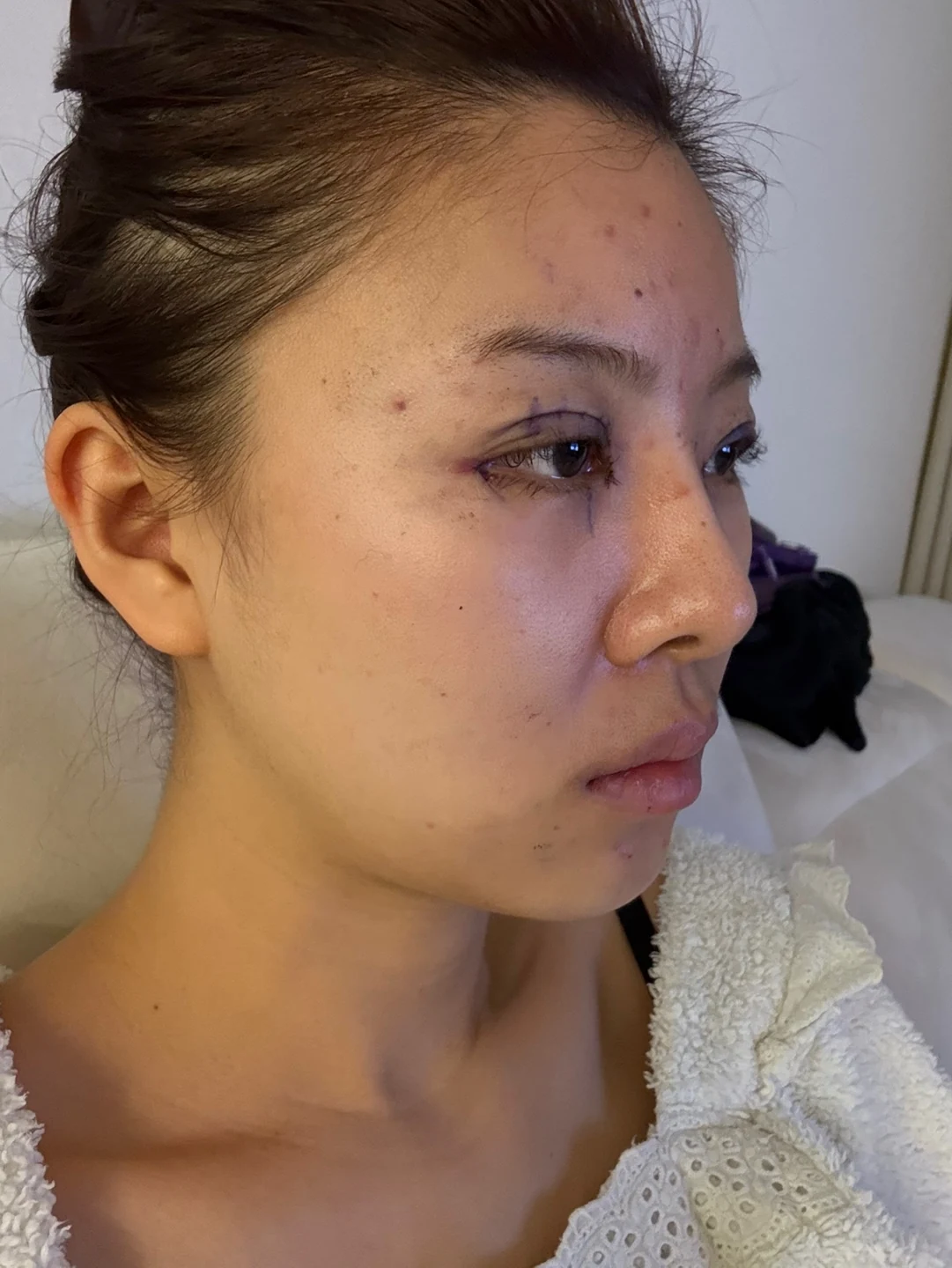 Eye surgery: the first month in photos · Case 027 at Answer Plastic Surgery. Oblique view — day of surgery at Answer Plastic Surgery.