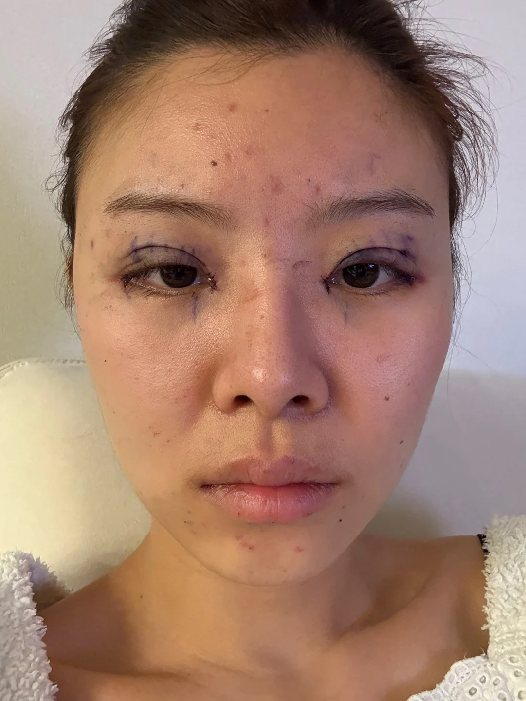 Eye surgery: the first month in photos · Case 027 at Answer Plastic Surgery. Front view with visible sutures — day of surgery at Answer Plastic Surgery.