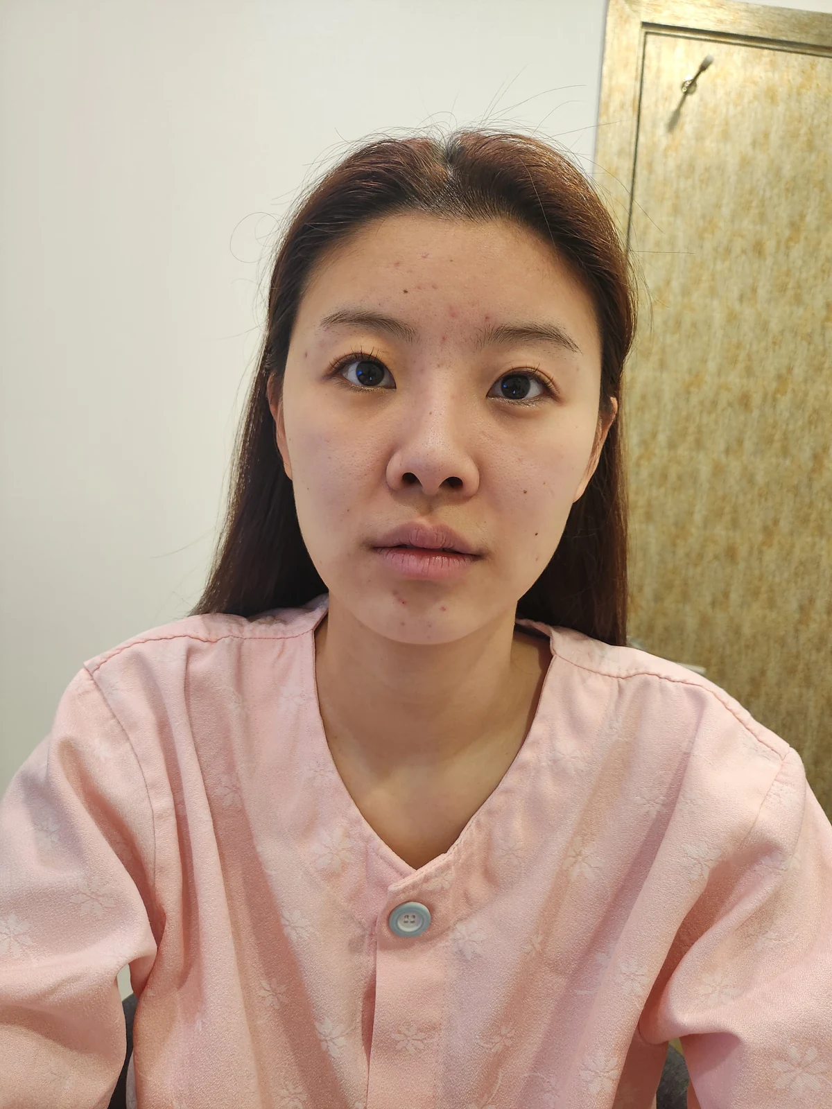 Eye surgery: the first month in photos · Case 027 at Answer Plastic Surgery. Front view — before at Answer Plastic Surgery.
