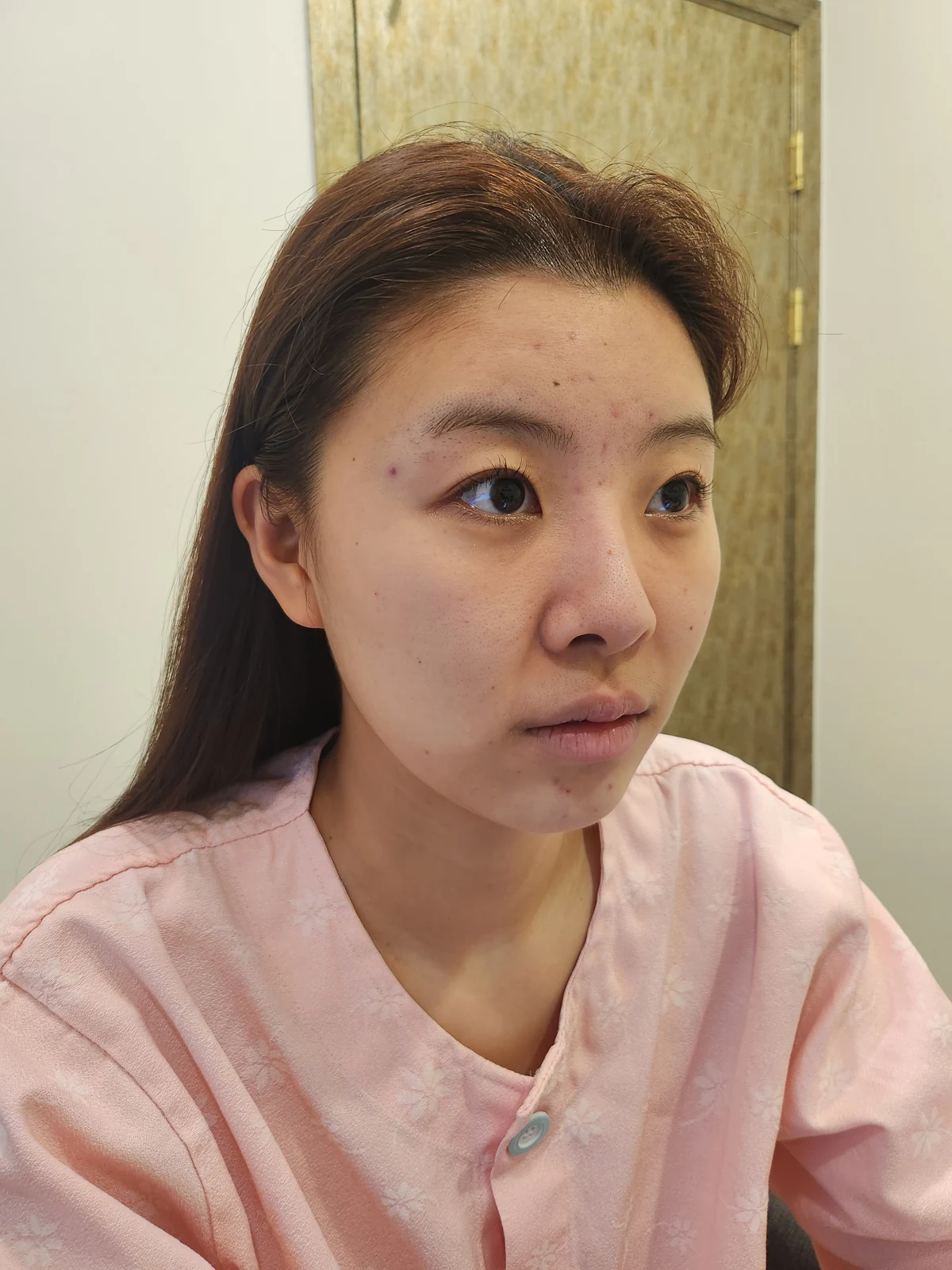 Eye surgery: the first month in photos · Case 027 at Answer Plastic Surgery. Oblique view — before at Answer Plastic Surgery.