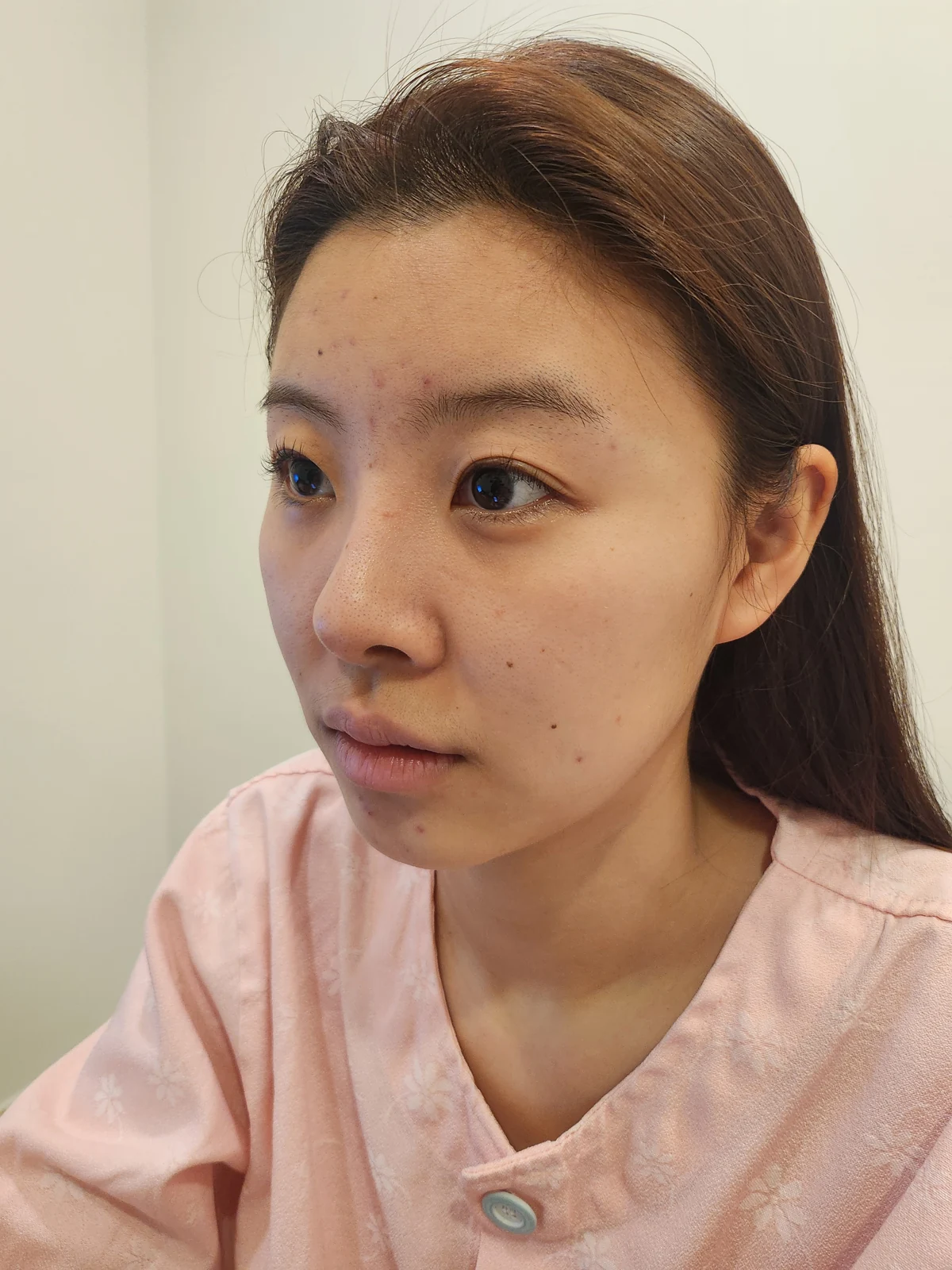 Eye surgery: the first month in photos · Case 027 at Answer Plastic Surgery. Opposite oblique view — before at Answer Plastic Surgery.