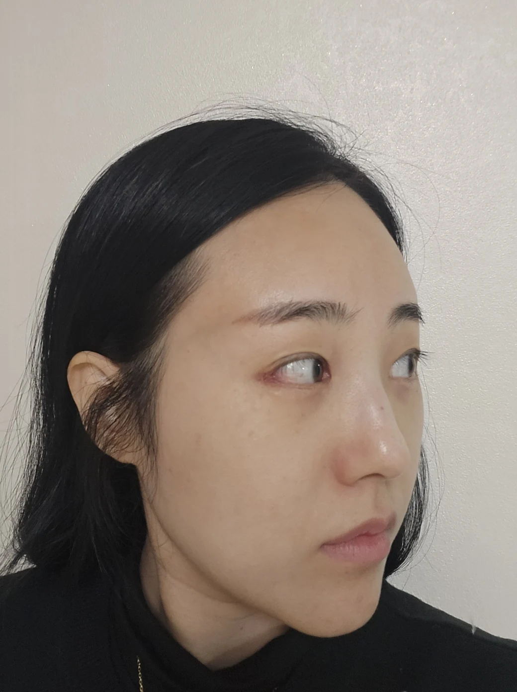 Revision outer-corner eye surgery: two-week follow-up · Case 028 at Answer Plastic Surgery. Oblique view — 1 week at Answer Plastic Surgery.