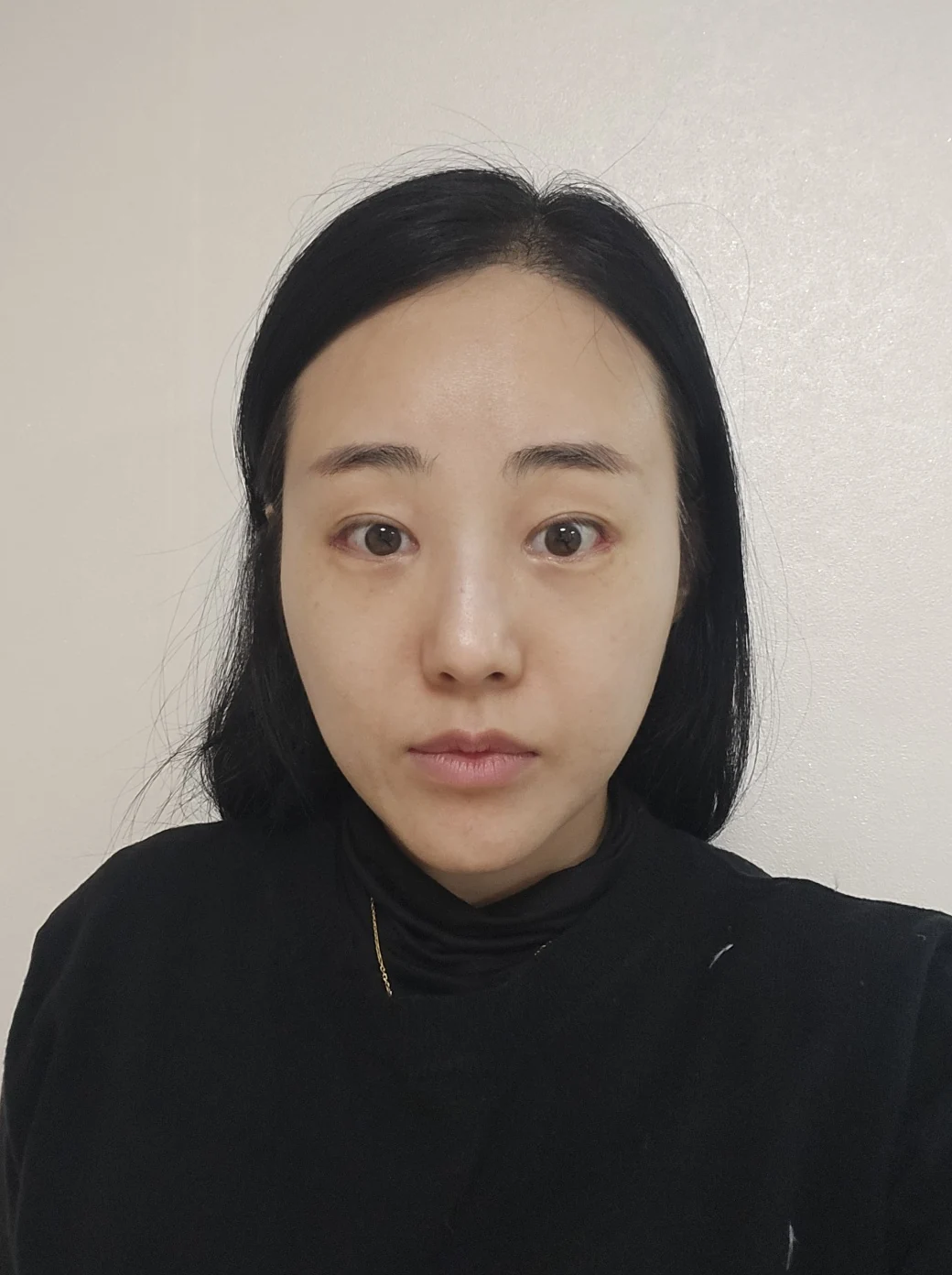 Revision outer-corner eye surgery: two-week follow-up · Case 028 at Answer Plastic Surgery. Front view — 1 week at Answer Plastic Surgery.