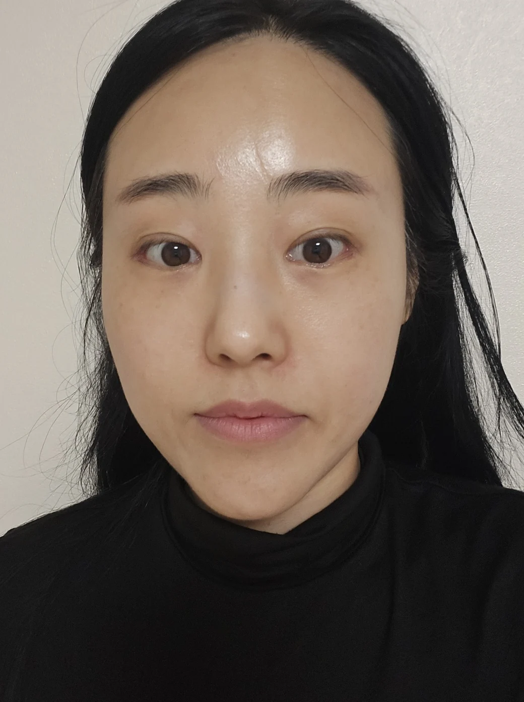 Revision outer-corner eye surgery: two-week follow-up · Case 028 at Answer Plastic Surgery. Front view — 2 weeks at Answer Plastic Surgery.