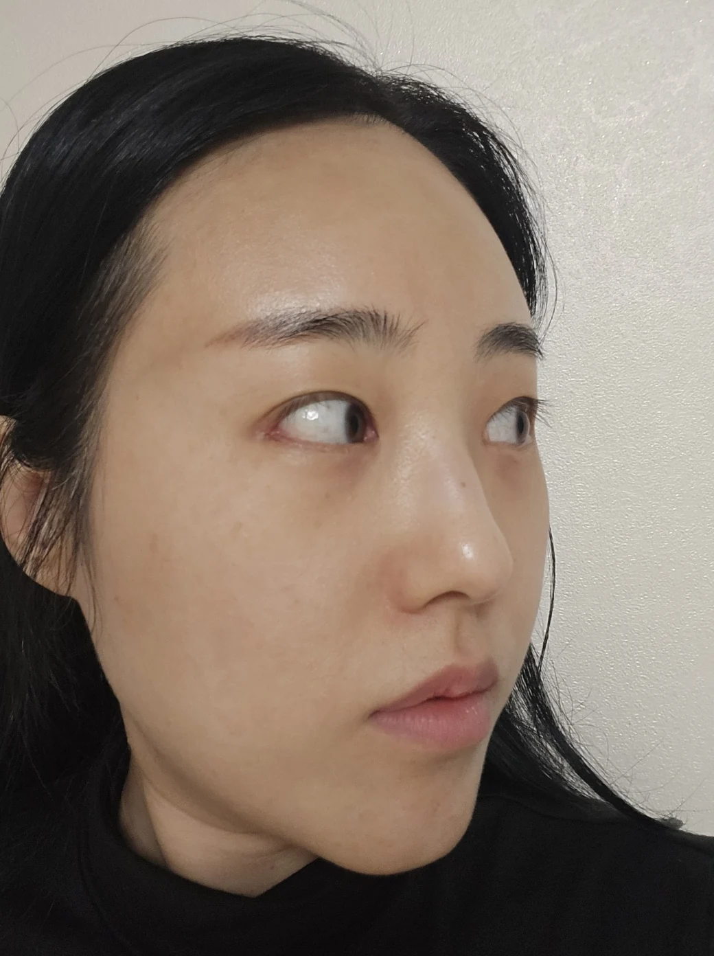 Revision outer-corner eye surgery: two-week follow-up · Case 028 at Answer Plastic Surgery. Oblique view — 2 weeks at Answer Plastic Surgery.
