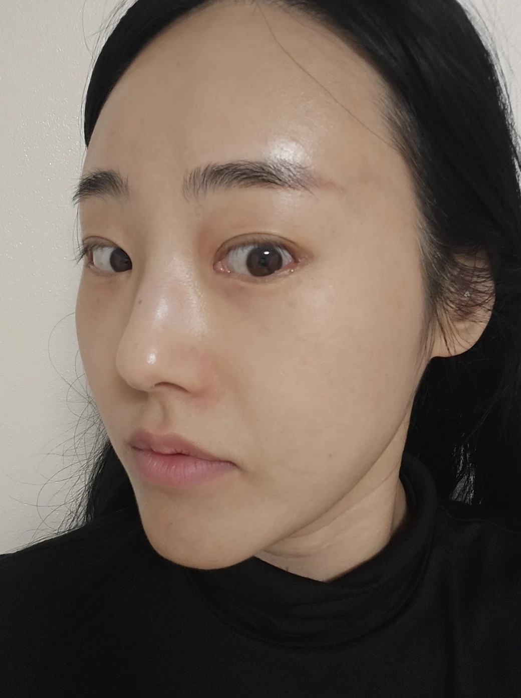 Revision outer-corner eye surgery: two-week follow-up · Case 028 at Answer Plastic Surgery. Opposite oblique view — 2 weeks at Answer Plastic Surgery.