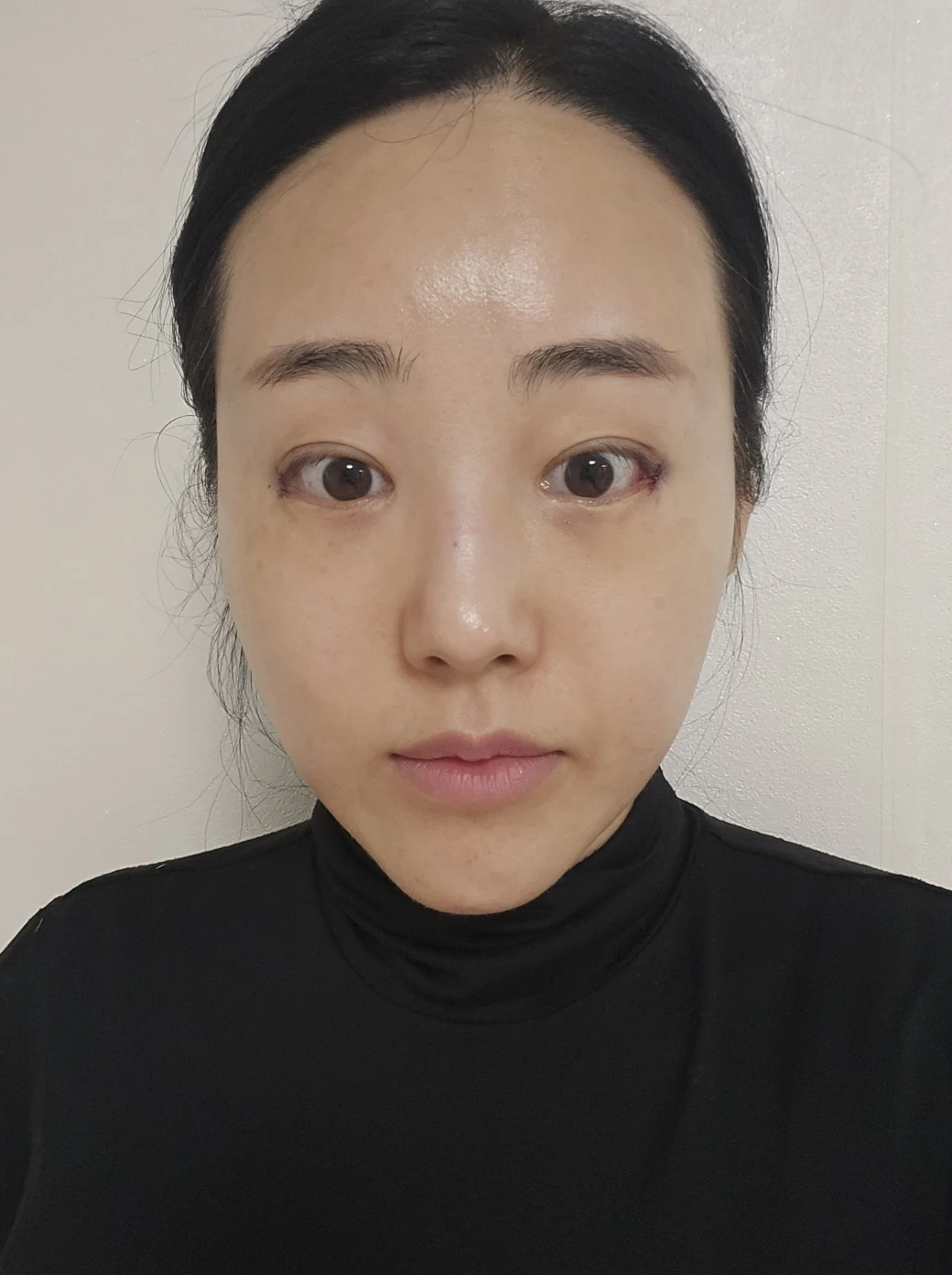 Revision outer-corner eye surgery: two-week follow-up · Case 028 at Answer Plastic Surgery. Front view — day of surgery at Answer Plastic Surgery.